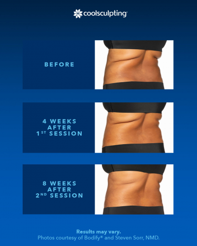 coolsculpting-before-after-1