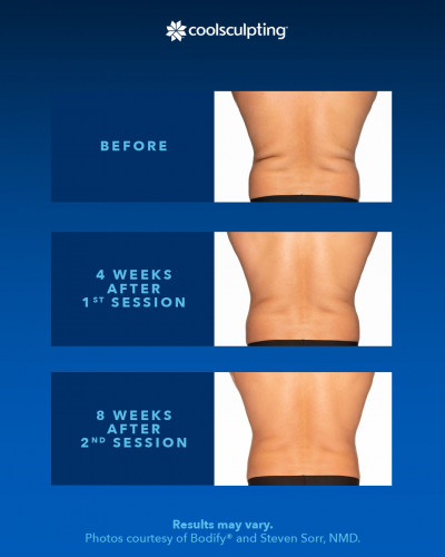 coolsculpting-before-after-2